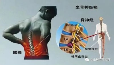 腰间盘突出锻炼方法及十个偏方