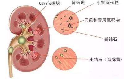 肾结石的形成原因