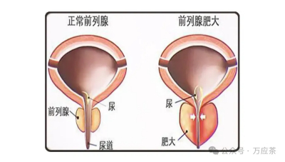 预防前列腺肥大要注意哪些